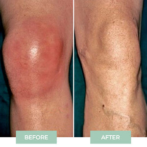 4x Pain Free UK™ Knee Massager - Temporary Relief From Joint Pain in Just 15 Minutes a Day*