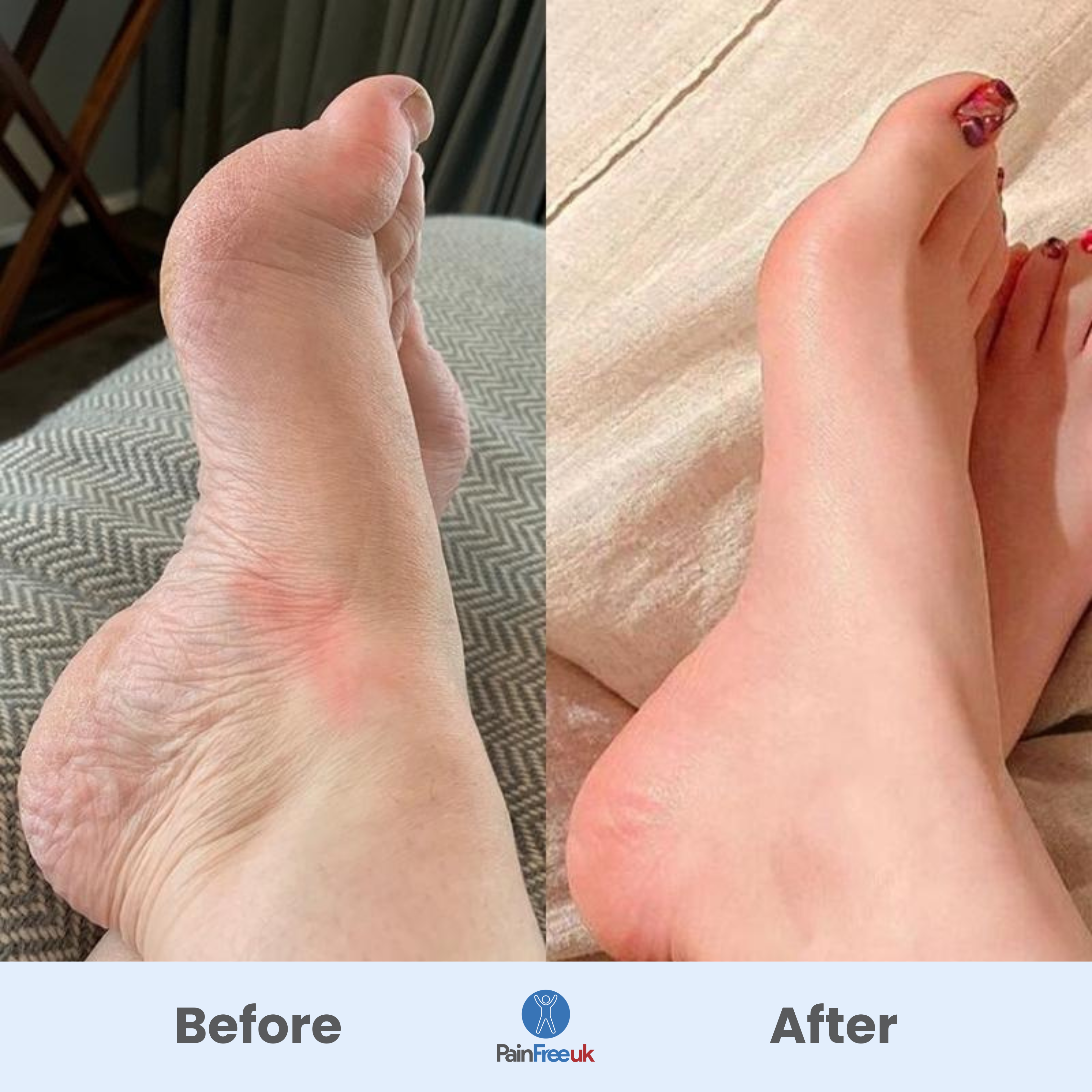 3x Pain Free UK™ Foot Massager - Quick Relief for Foot Pain in Just 15 Minutes a Day*