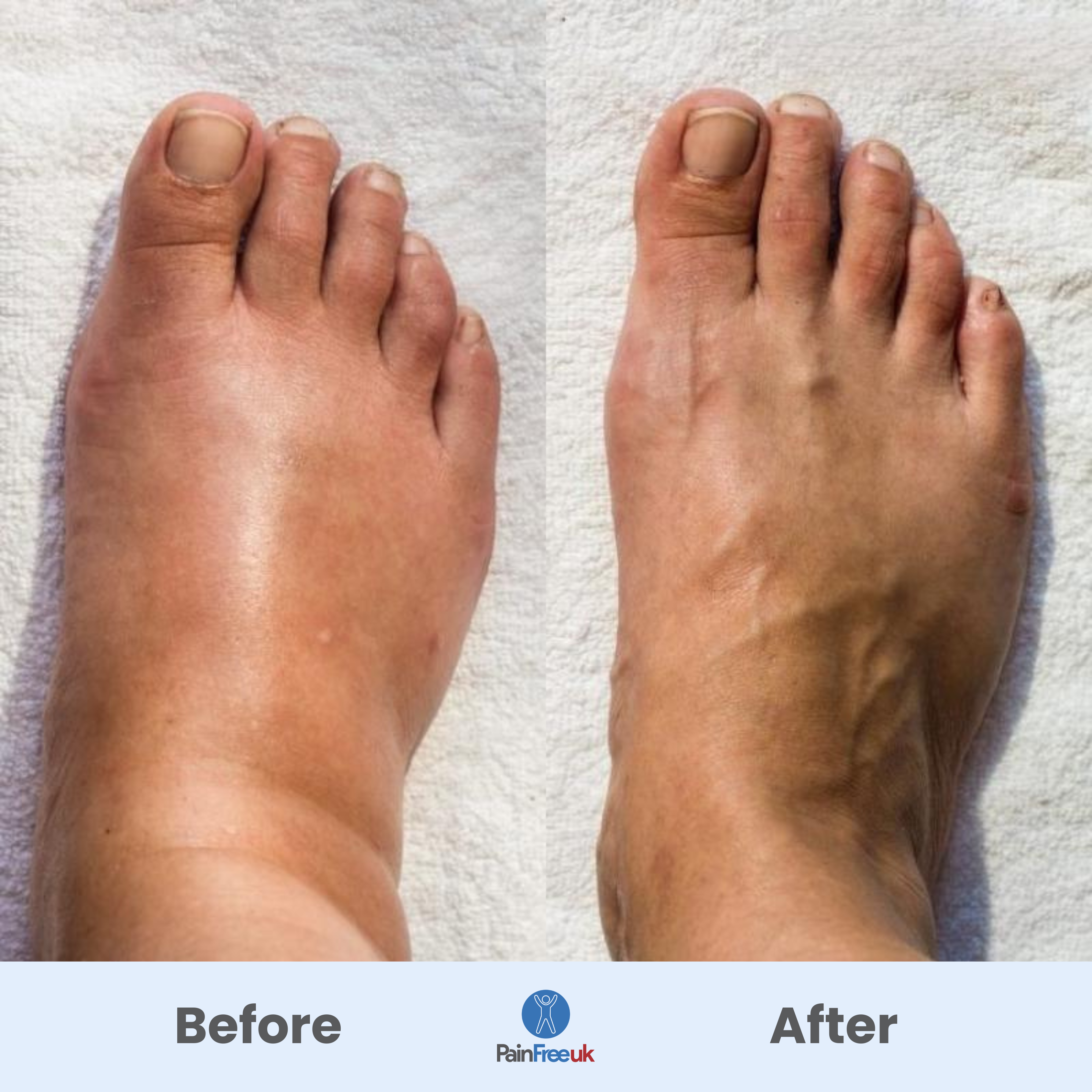 4x Pain Free UK™ Foot Massager - Quick Relief for Foot Pain in Just 15 Minutes a Day*